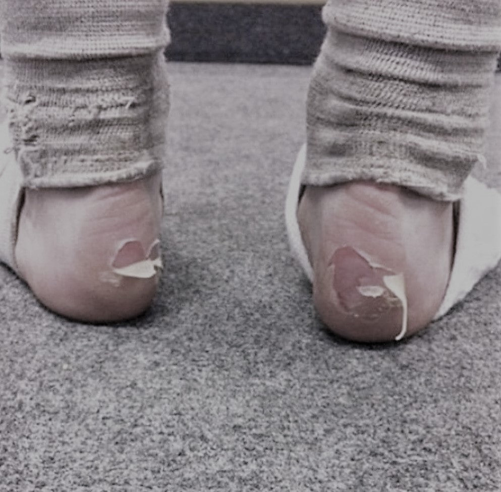 Surviving Blisters and Training in Comfort (yes, it can be done!)